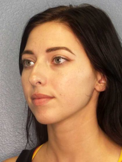 Rhinoplasty Before & After Patient #12362