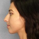 Rhinoplasty Before & After Patient #12362