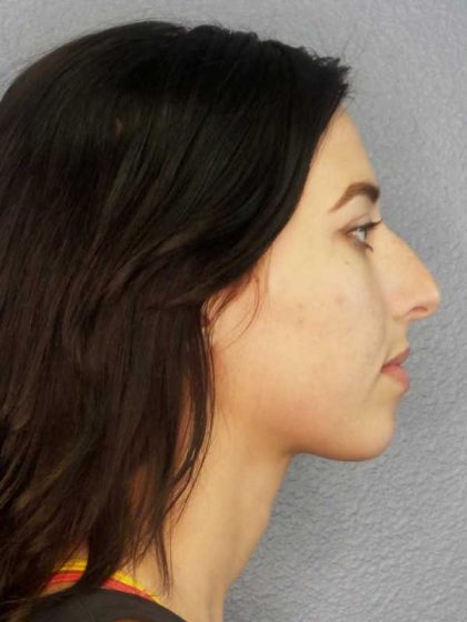 Rhinoplasty Before & After Patient #12362