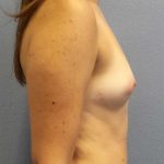 Breast Augmentation Before & After Patient #11385