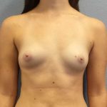 Breast Augmentation Before & After Patient #11385