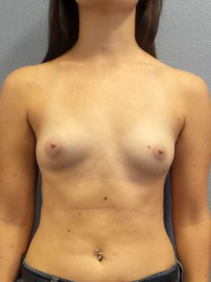 Breast Augmentation Before & After Patient #11385