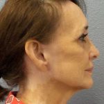 Facelift Before & After Patient #11672