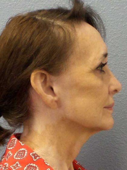 Facelift Before & After Patient #11672