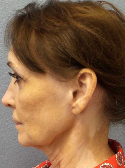 Facelift Before & After Patient #11672
