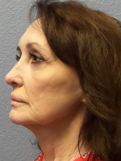 Facelift Before & After Patient #11672
