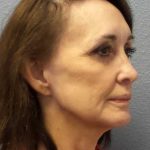 Facelift Before & After Patient #11672