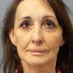 Facelift Before & After Patient #11672