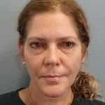 Facelift Before & After Patient #7572