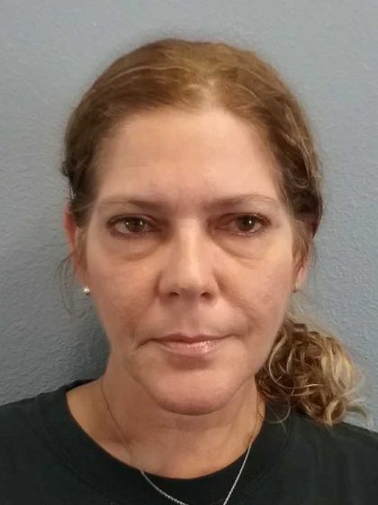 Facelift Before & After Patient #7572