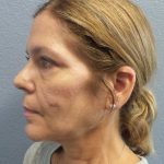 Facelift Before & After Patient #7572
