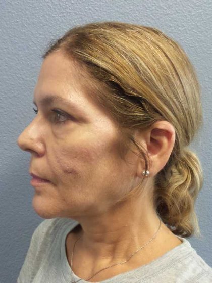 Facelift Before & After Patient #7572