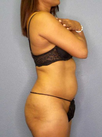 Liposuction Female Before & After Patient #11994