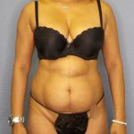 Liposuction Female Before & After Patient #11994