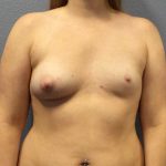 Asymmetric (Uneven) Breasts Before & After Patient #11167