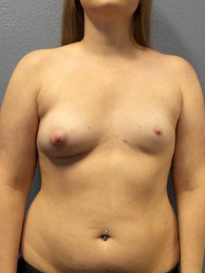 Asymmetric (Uneven) Breasts Before & After Patient #11167