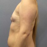Asymmetric (Uneven) Breasts Before & After Patient #11167
