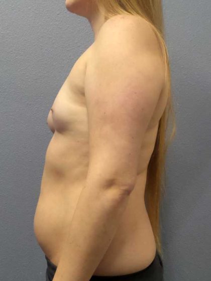 Asymmetric (Uneven) Breasts Before & After Patient #11167