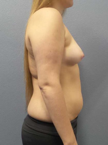 Asymmetric (Uneven) Breasts Before & After Patient #11167