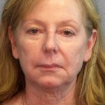 Facelift Before & After Patient #11876