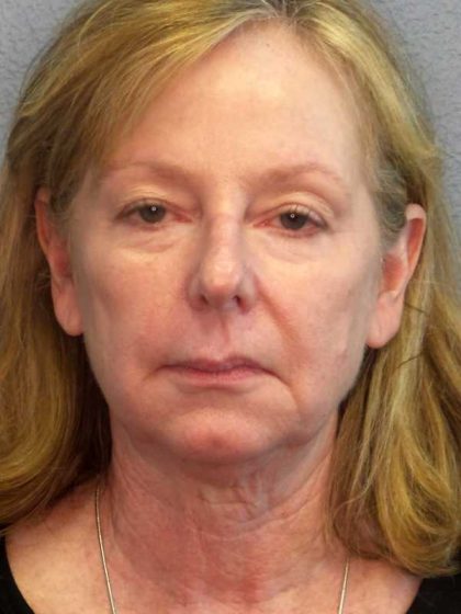 Facelift Before & After Patient #11876