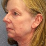 Facelift Before & After Patient #11876