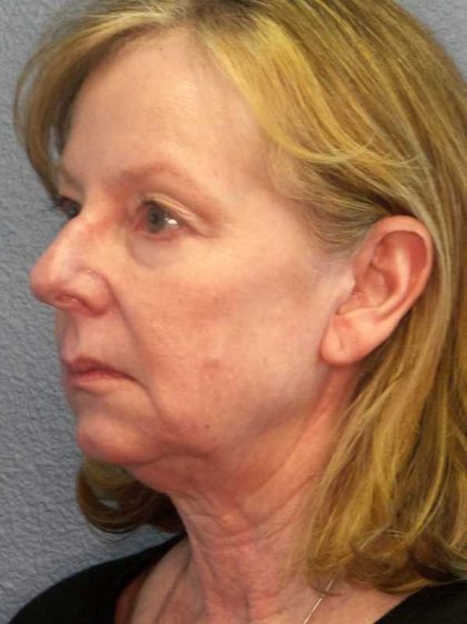 Facelift Before & After Patient #11876
