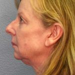 Facelift Before & After Patient #11876