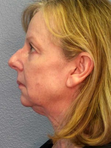 Facelift Before & After Patient #11876