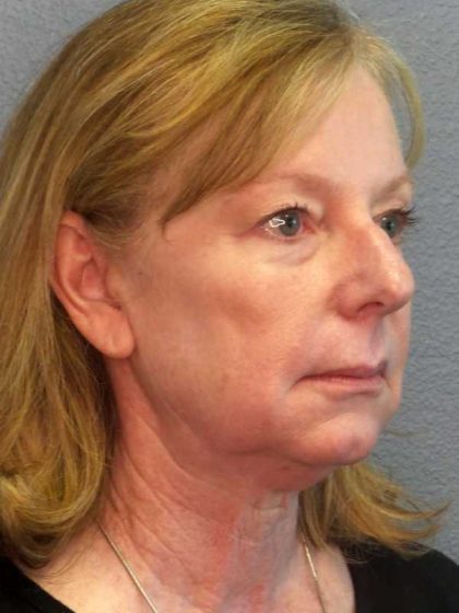 Facelift Before & After Patient #11876