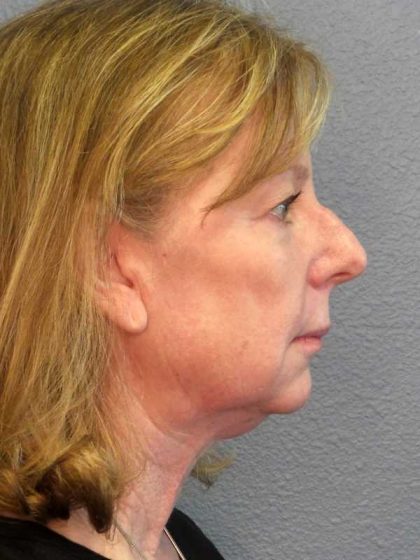 Facelift Before & After Patient #11876