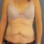 Abdominoplasty Before & After Patient #11097
