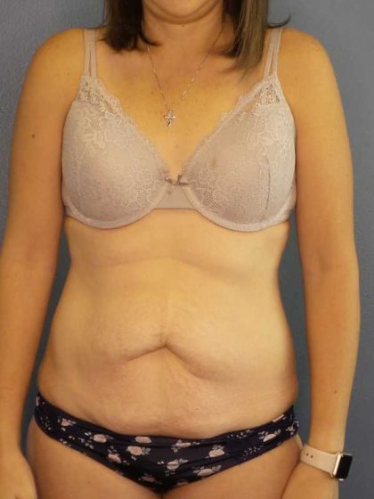 Abdominoplasty Before & After Patient #11097