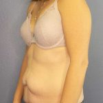 Abdominoplasty Before & After Patient #11097