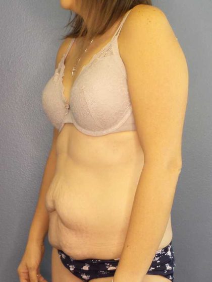 Abdominoplasty Before & After Patient #11097