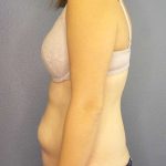 Abdominoplasty Before & After Patient #11097