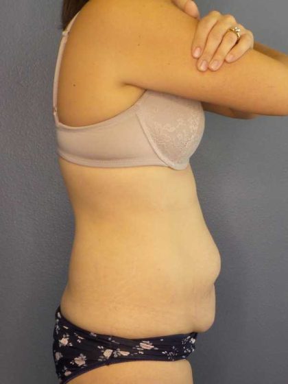 Abdominoplasty Before & After Patient #11097