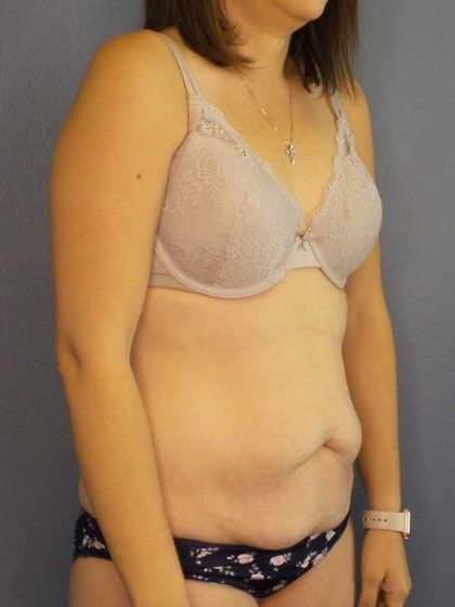 Abdominoplasty Before & After Patient #11097