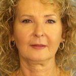 Facelift Before & After Patient #11756