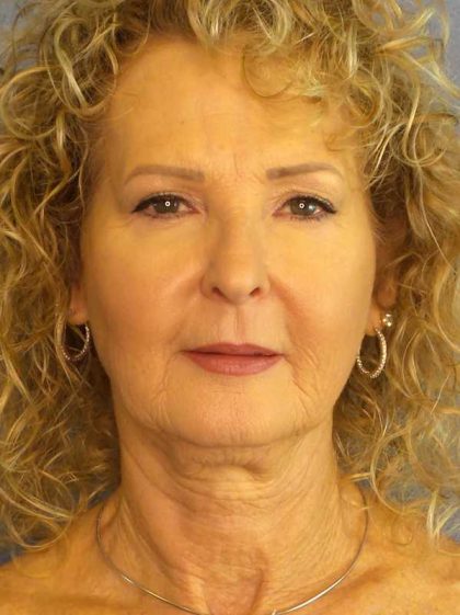 Facelift Before & After Patient #11756