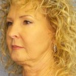 Facelift Before & After Patient #11756