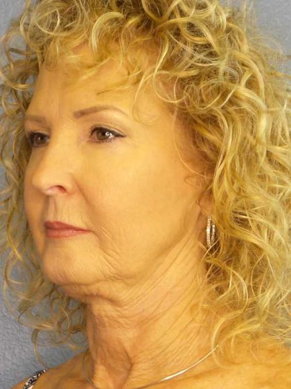 Facelift Before & After Patient #11756