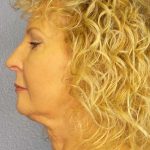 Facelift Before & After Patient #11756