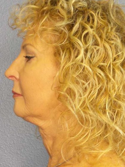 Facelift Before & After Patient #11756