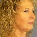 Facelift Before & After Patient #11756