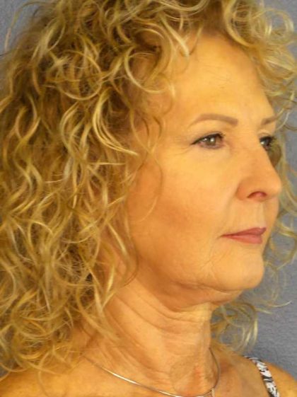 Facelift Before & After Patient #11756