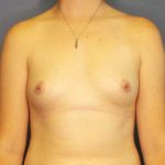 Breast Augmentation Before & After Patient #11367