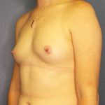 Breast Augmentation Before & After Patient #11367