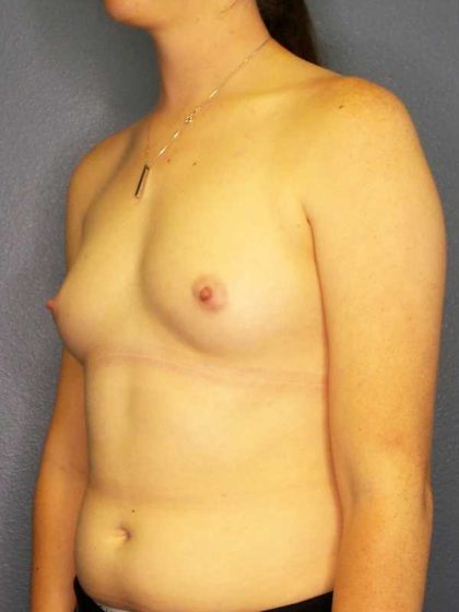 Breast Augmentation Before & After Patient #11367