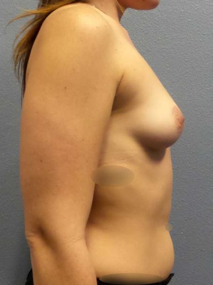 Breast Augmentation Before & After Patient #11487